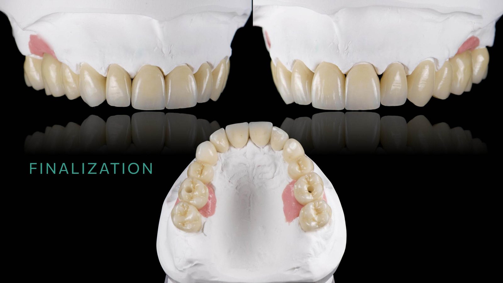 Kalotas-implants-Finalization